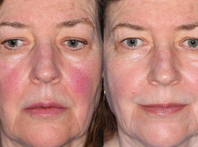 Before and after BBL treatment for rosacea. Image provided by Sciton Inc.