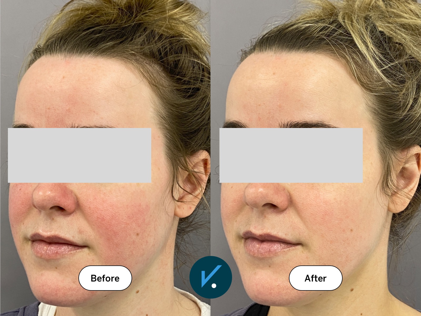 Before and after rosacea treatment medication and a course of BBL