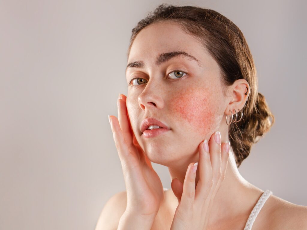 Rosacea triggers: Understanding the causes of rosacea