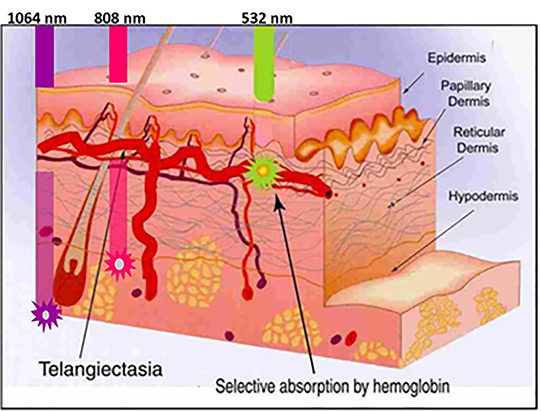 Cross-section of skin showing absorption of different light wavelengths