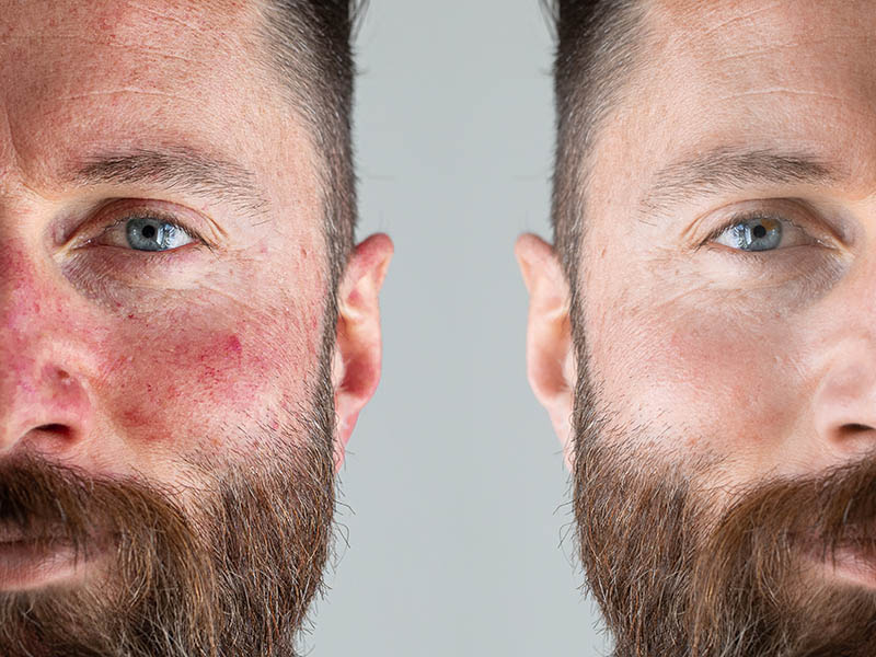 Face of a man with flushed cheek skin. Before and after a rosacea laser treatment. Half face with and without redness.