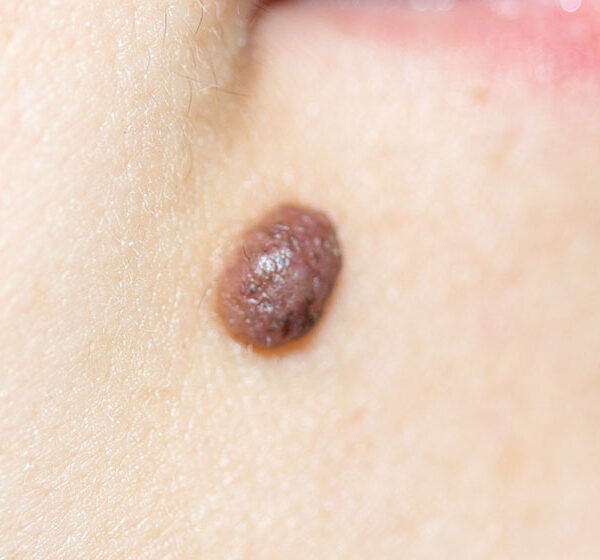 Close-up view of a dermal naevus