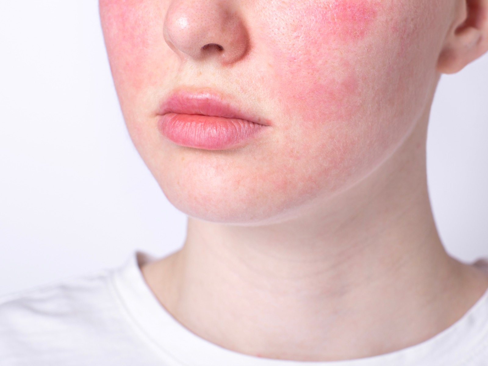 A young person with rosacea