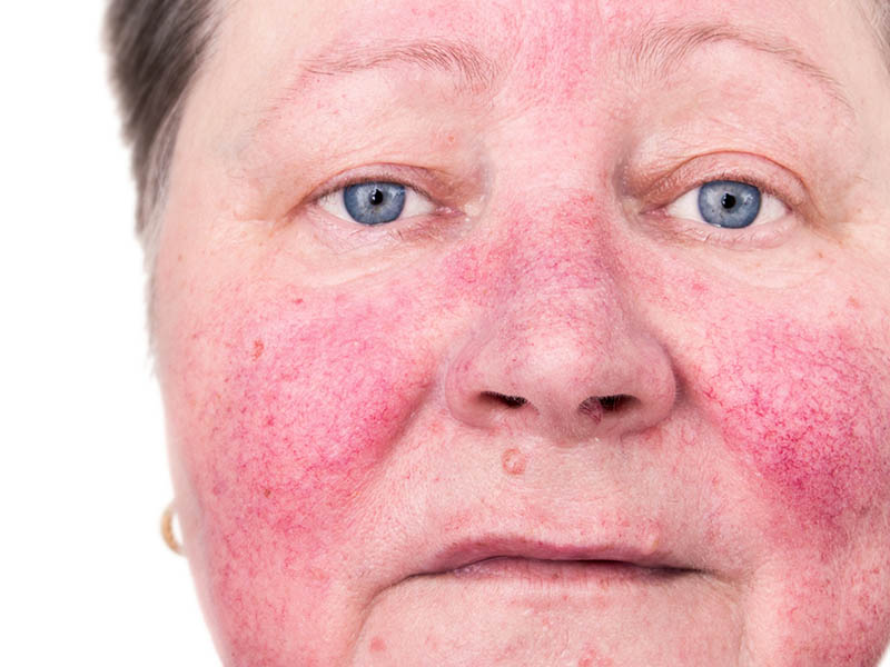 Woman with rosacea affecting cheeks, nose and forehead