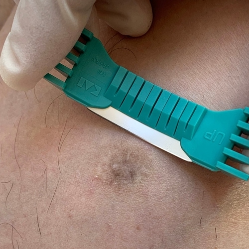 Shave biopsy