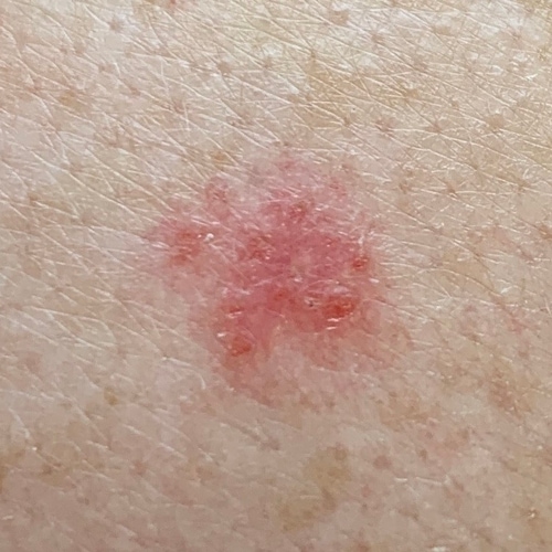 Superficial basal cell carcinoma