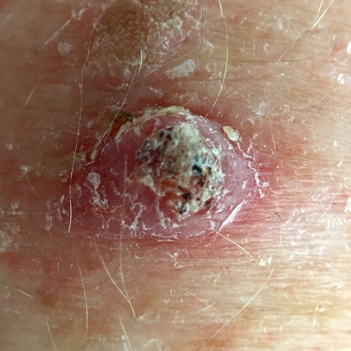 Squamous cell carcinoma