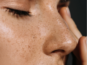 Freckle removal treatment: What are the options for freckle removal?