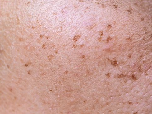 Close up of skin spots