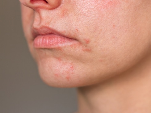 Close-up photo of the face showing rosacea