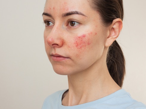 Photo of a woman showing rosacea across face