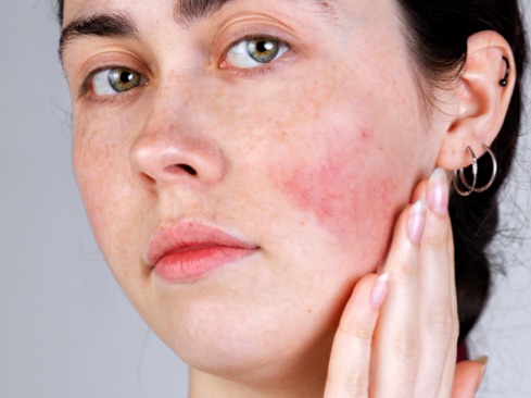 Photo of a woman showing rosacea flairup