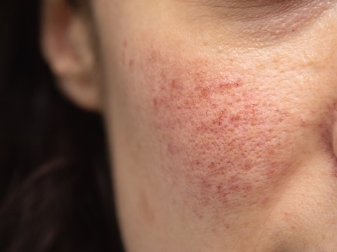 Photo of the cheek showing rosacea