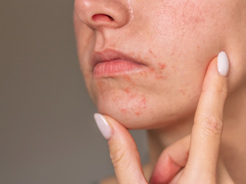 Photo of the face showing rosacea