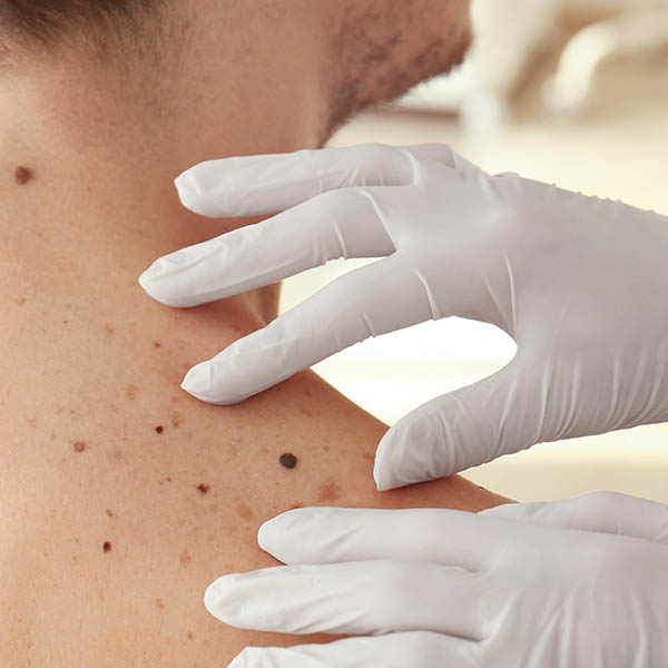 Examining moles on a man's shoulder