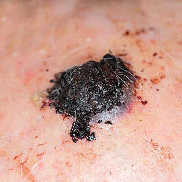 Close-up view of melanoma