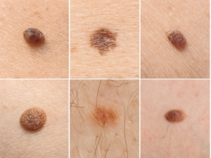 Understanding the different types of moles