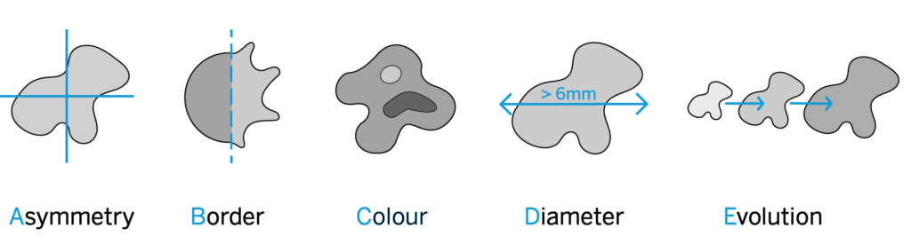 ABCDE rule for detecting skin cancers