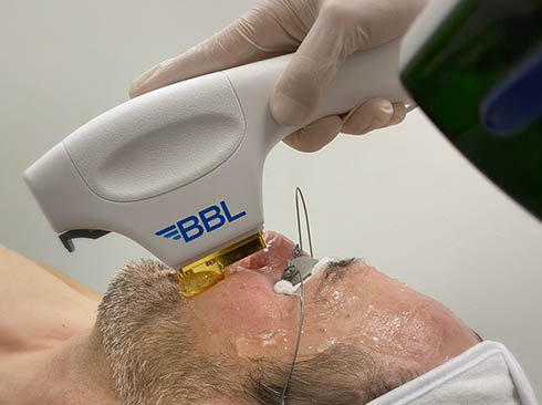 BBL treatment of a man's face