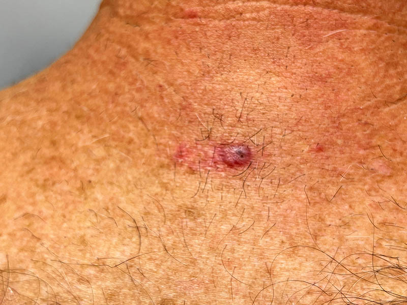 Basal cell carcinoma on the upper back.