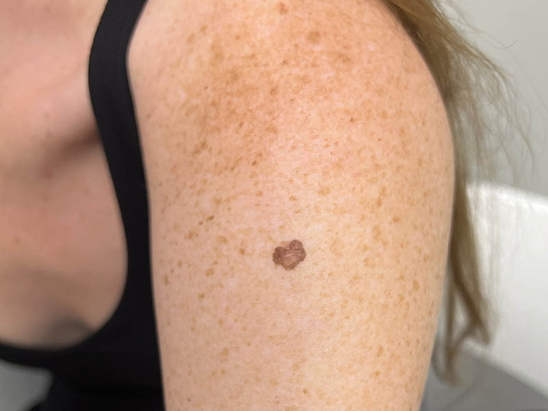 Melanoma in situ on the left upper arm of a young woman