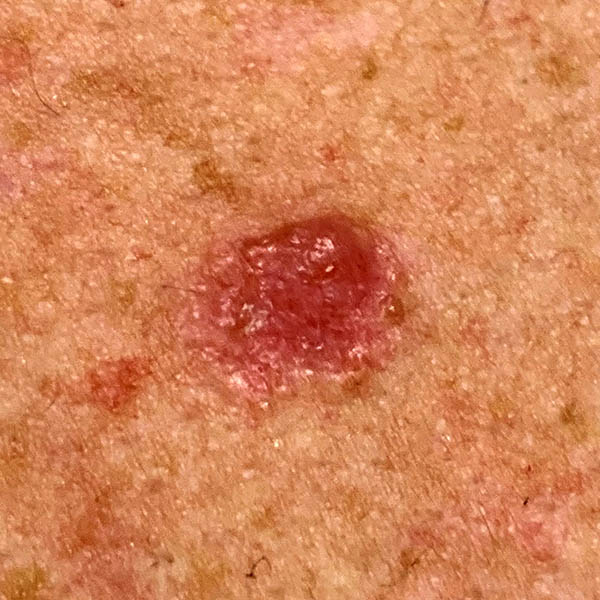 Basal cell carcinoma (BCC), close-up view