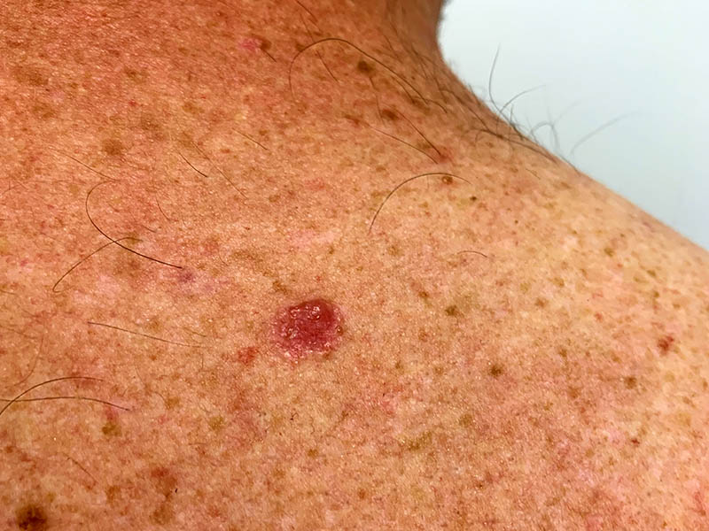 Basal cell carcinoma (BCC), right upper back