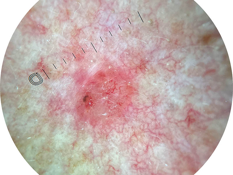 Dermoscopic view of a basal cell carcinoma showing characteristic branching bright red blood vessels.