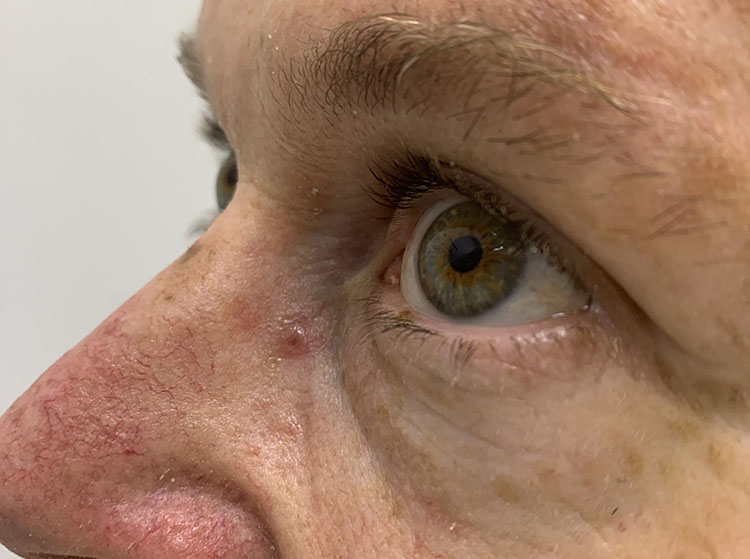 Basal cell carcinoma on the left side of the nose