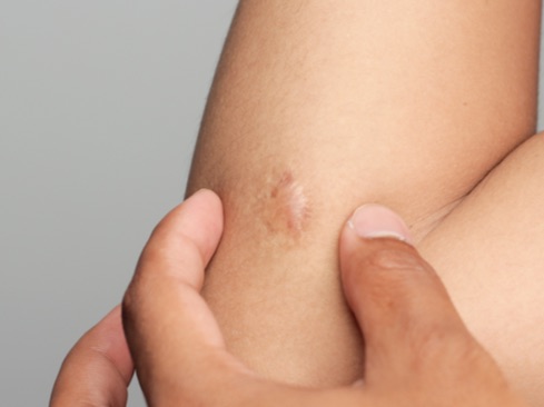 Scar on human skin keloid on elbow