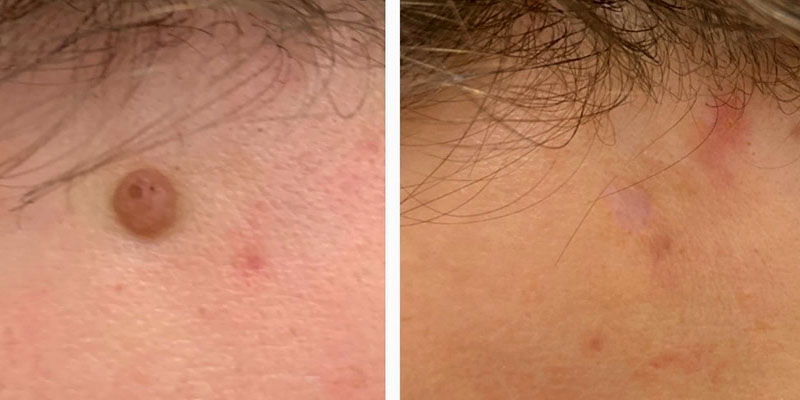 Before and 4 months after radiofrequency mole removal. Outcome is specific to this particular patient and may not reflect the results experienced by other individuals. 