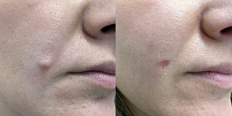 Before and 4 weeks after radiofrequency mole removal