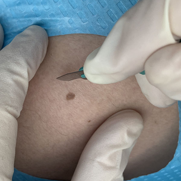 Excision of a pigmented skin lesion using a scalpel