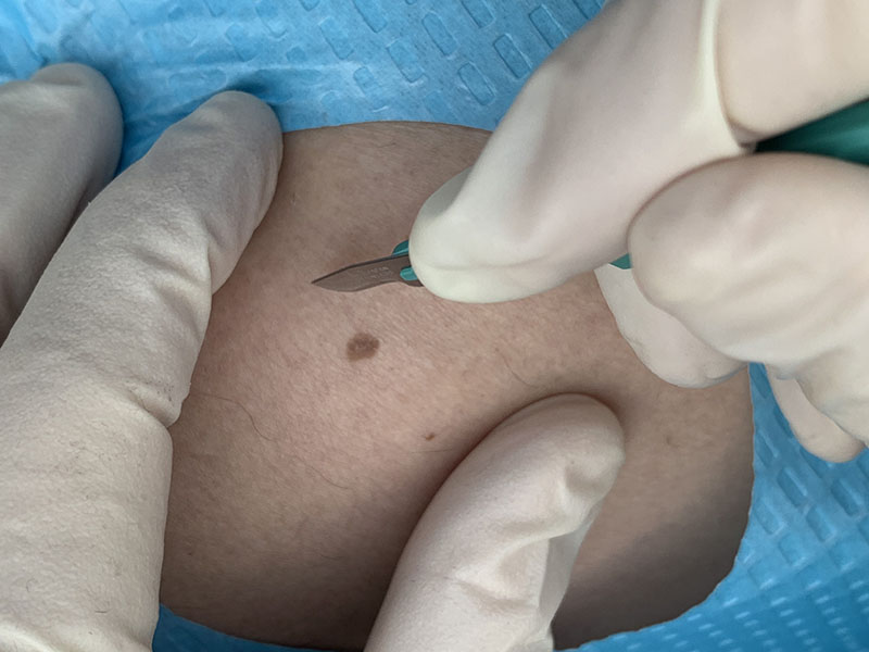 Excision of a pigmented skin lesion using a scalpel