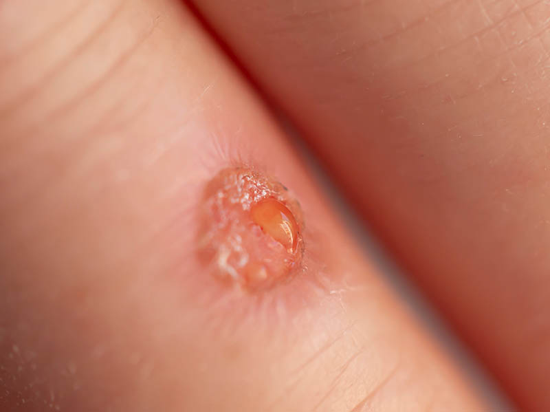 Skin wound discharging exudate