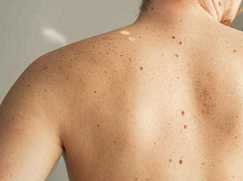 Mole vs. freckle: Understanding the difference between moles and freckles