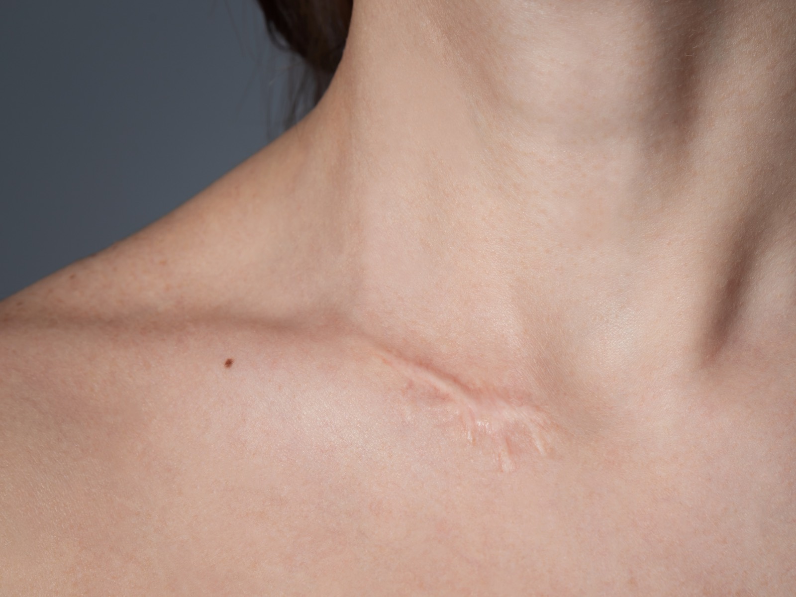 Hypertrophic scar on a woman's left shoulder blade