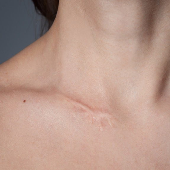 Hypertrophic scar on a woman's shoulder blade