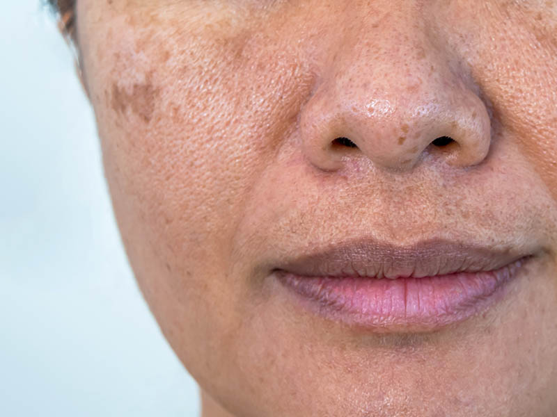 Close-up photo of a woman's face. Multiple freckles and a large irregular lentigo on her cheek.