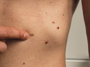 How to check your moles for cancer