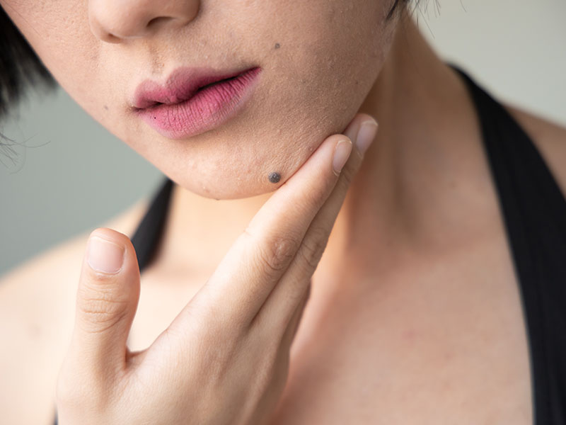 Lower half of a woman's face with dark moles on her chin and cheeks.