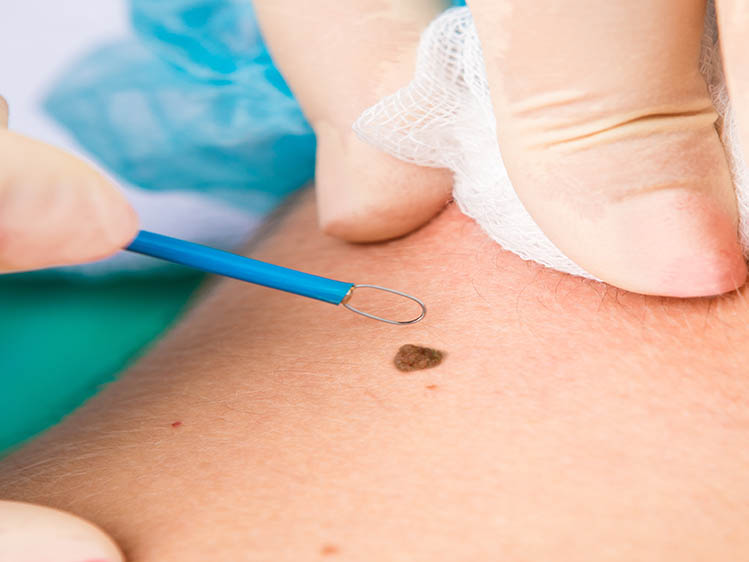 Radiofrequency surgery of a raised mole on the back of the neck.