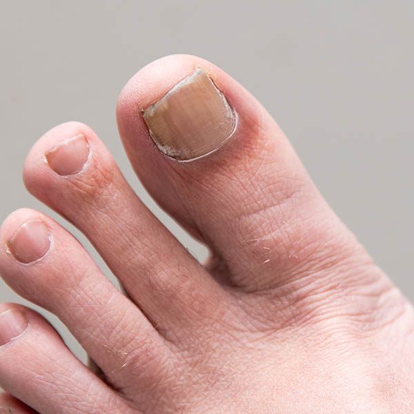 Male foot onychomycosis fungal nail infection