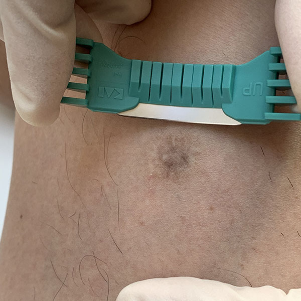 Shave biopsy