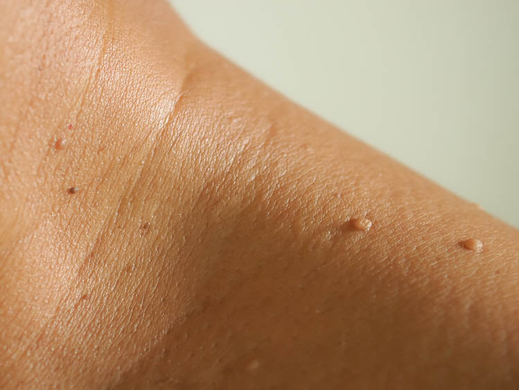 Skin tags on the neck and shoulder