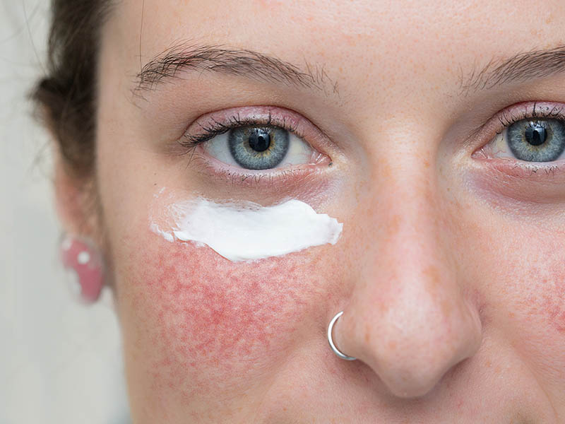 Young woman with rosacea, cream is applied to her right cheek