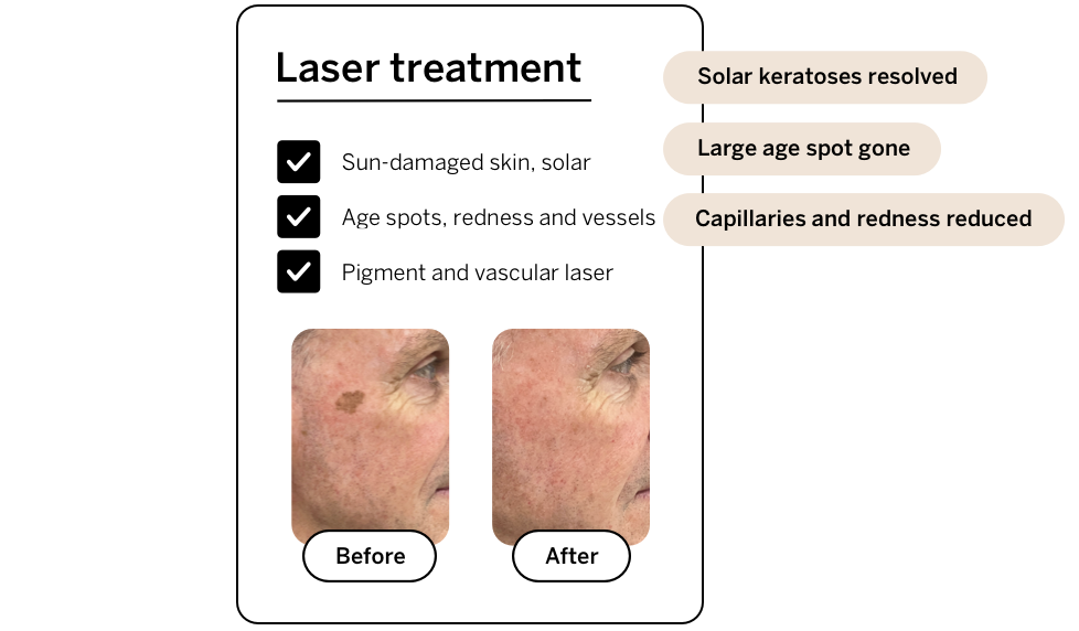 Before and after aser treatment for solar keratoses, vascular, lentigines