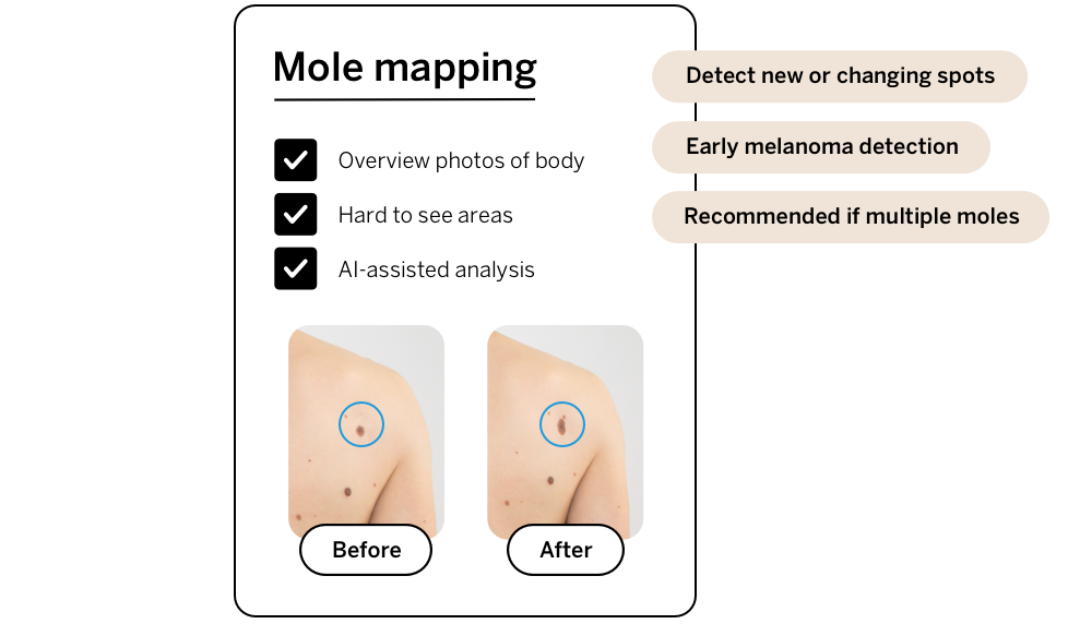 Mole mapping: before and after