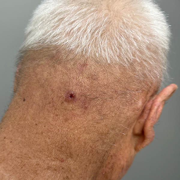 Nodular basal cell carcinoma on the back of the scalp