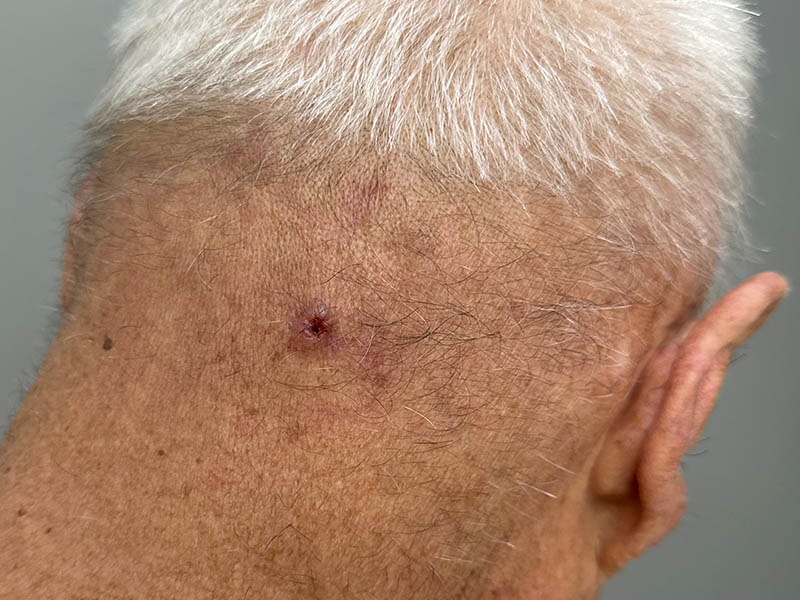 Nodular basal cell carcinoma on the back of the scalp